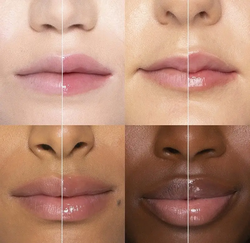 Lipfillers nabij Amsterdam
