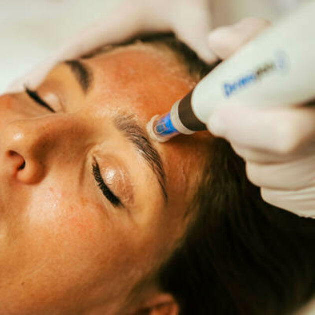 Microneedling met dermapen