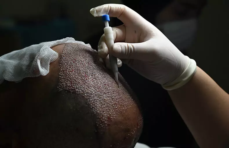 DHI haartransplantatie