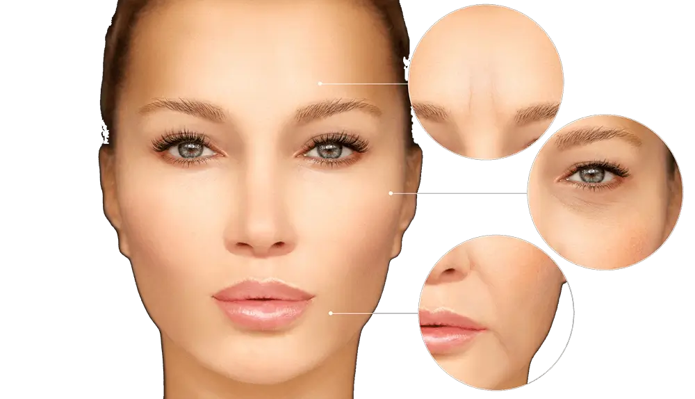 Microneedling-rf-amsterdam
