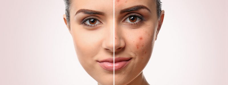 Acne behandelen bij rijkskliniek
