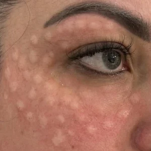 Zalm-DNA ogen littekens